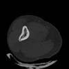 SPORK, NICO - 22.03.1976 - 02.08.2022 - CT obere Extremität - 17:51:17